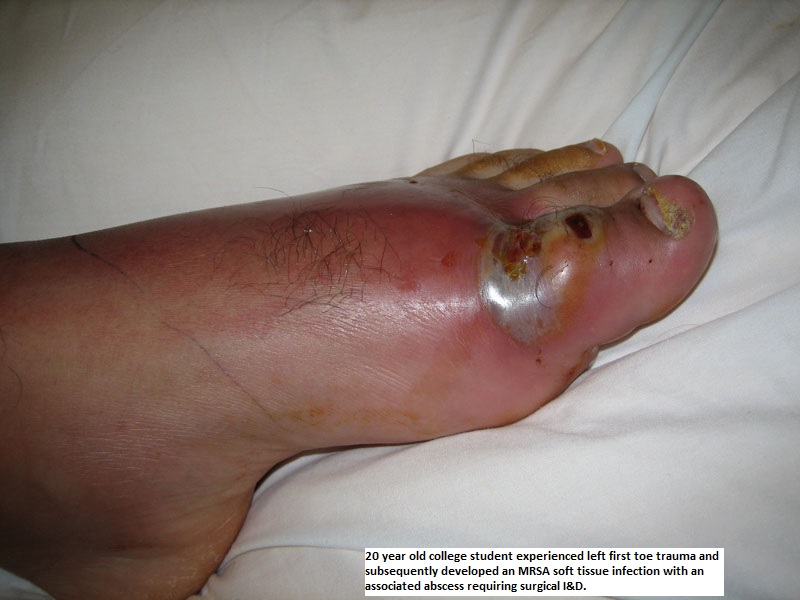 Cellulitis - Infectious Disease and Antimicrobial Agents