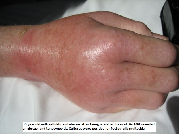 Cellulitis - Infectious Disease and Antimicrobial Agents