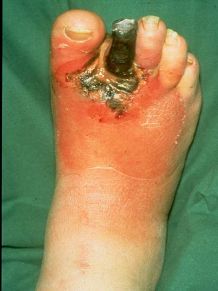 Cellulitis-Topic Overview – WebMD