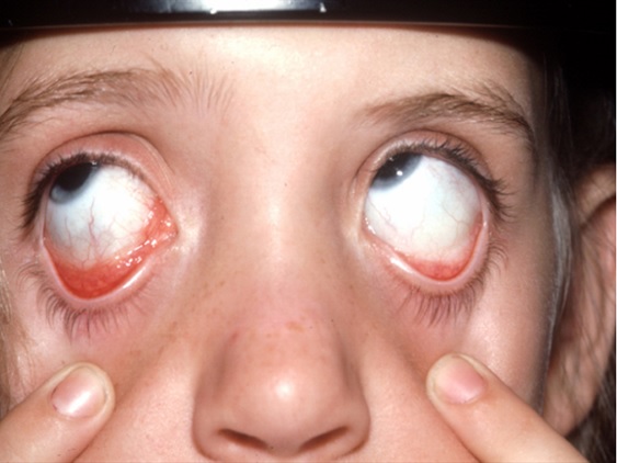 Eyelid Inflammation (Blepharitis) - eMedicineHealth