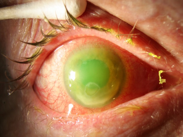 Corneal abrasion facts, information, pictures ...