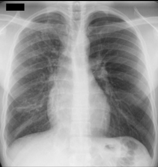 What treatments are available for persistent pulmonary infiltrate?