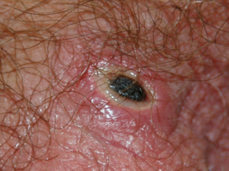pimple like bumps on scalp - Dermatology - MedHelp