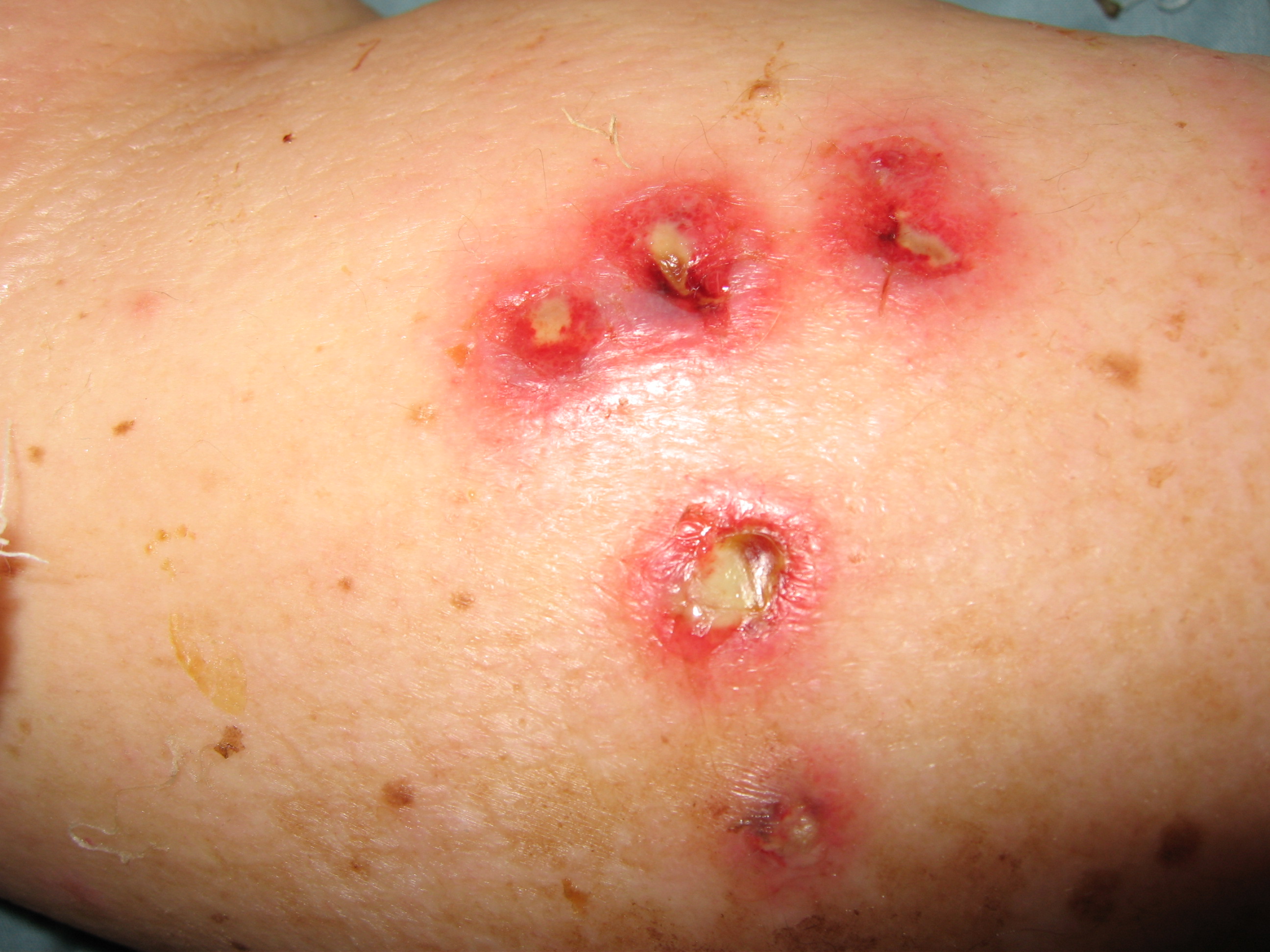 Ecthyma gangrenosum | DermNet New Zealand