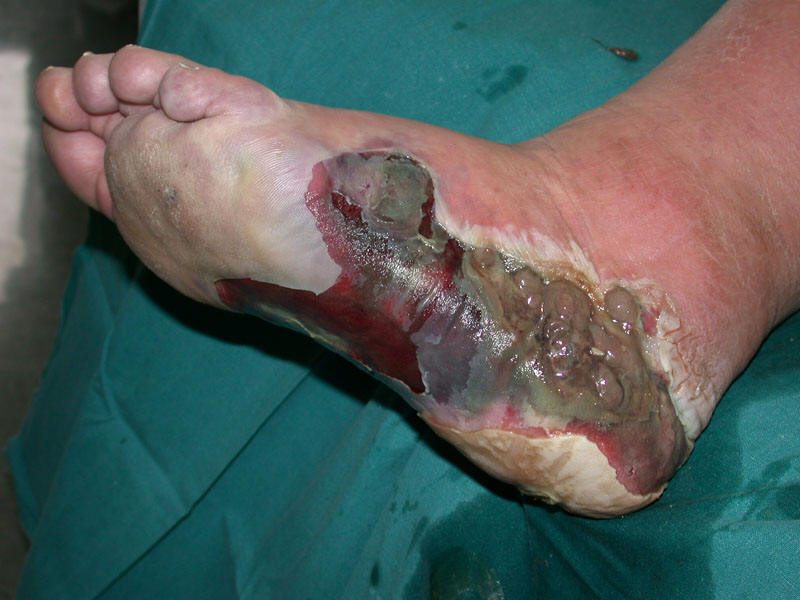 infected feet #10